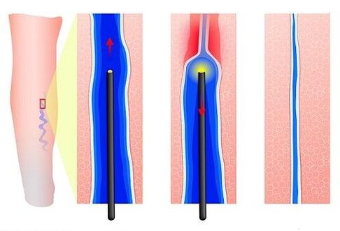 Laserkoagulation