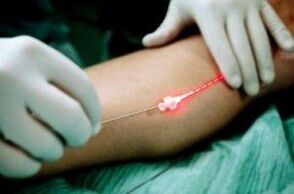 Laserbehandlung von Krampfadern in den Beinen