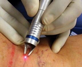 Wie man Laserbehandlung von Krampfadern durchführt