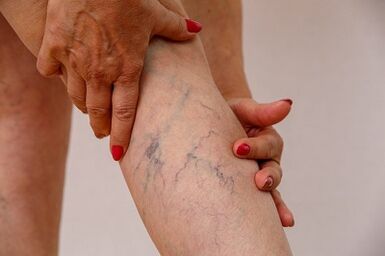 Krampfadern der unteren Extremitäten