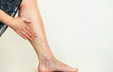 Wie behandelt man Krampfadern der unteren Extremitäten