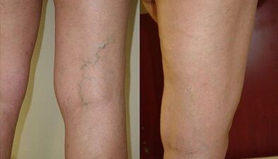 Mikrophlebektomie bei Krampfadern