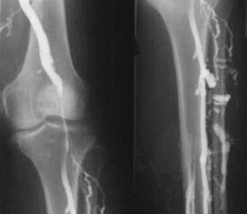 Diagnosemöglichkeiten bei Krampfadern der Extremitäten.